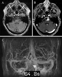 A brain aneurysm is a weakness in a blood vessel in the brain. Comprehensive Review Of Imaging Of Intracranial Aneurysms And Angiographically Negative Subarachnoid Hemorrhage In Neurosurgical Focus Volume 47 Issue 6 2019