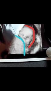 Ein zwilling braucht abwechslung, er braucht bewegung und er fühlt sich nur wohl, wenn etwas um ihn herum los ist. 2 Babys Versteckter Zwilling Schwangerschaft Schwanger Zwillinge