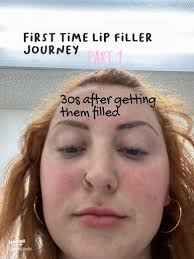 My Lip Filler Journey: The First Week of Transformation