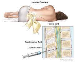 Adult Non Hodgkin Lymphoma Treatment Pdq Patients Siteman Cancer Center