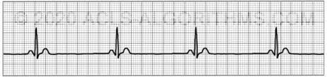 Ekg Practice Test 1 Learn Master Acls Pals