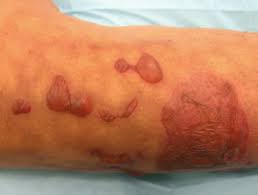 We did not find results for: Thermal Burn Dermnet Nz