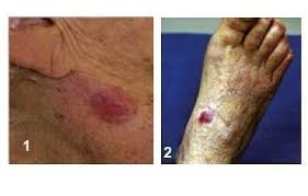 These tumors originate from sensory merkel cells. Merkel Cell Carcinoma Charleston Wv Dermatologist