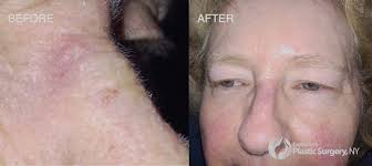 According to the american cancer society, just over 100,000 new cases of skin cancer are diagnosed in the united states each year. Case Basal Cell Skin Cancer Of The Nose And Skin Graft Reconstruction Cosmetic Reconstructive Md