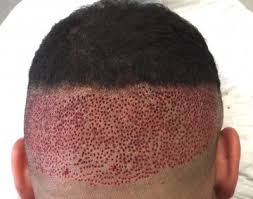 However, the effect did not produce a result that was natural in appearance or convincing. We Use Cookies To Provide Our Services By Using This Website You Agree To This Ok More Information Compare 250 Clinics In Europe Francais English Spanish German Hair Clinics In Europe All Clinics Clinics By Country Clinics By Prices Receive