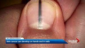 View photos of basal cell carcinoma, squamous cell carcinoma, melanoma, and kaposi sarcoma. When Melanoma Hides Woman Develops Skin Cancer Under Her Nail National Globalnews Ca