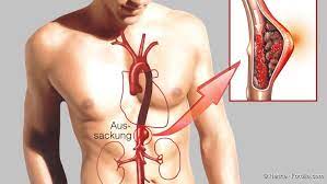 Aneurysma Formen Warnzeichen Ursachen Erste Hilfe Netdoktor