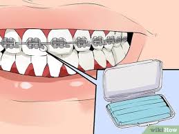 How to remove your braces at home (when you have no choice) i am just showing you how i remove my brace at home. How To Fix A Broken Braces Wire 6 Steps With Pictures Wikihow