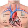 Permanent epicardial pacemakers are used occasionally in pediatric patients with congenital heart disease. 1