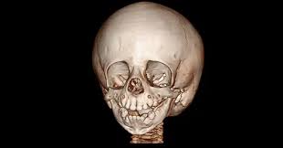 Extraordinarios Da Vida Real Os Desafios Da Sindrome De Treacher Collins Pebmed