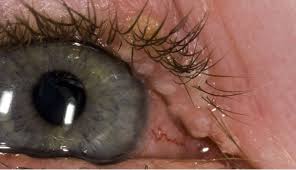 Now i want to obtain single channels hue, value and saturation separately. Herpes Simplex Virus 1 2 Clinical Advisor