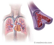 A pulmonary embolism is a blood clot that takes place in the lungs. Pulmonary Embolism