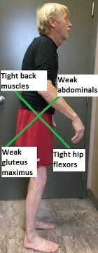 Upper And Lower Cross Syndrome Back To Health Wellness Centre