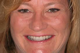 Dental Bridges & Crowns