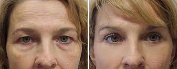 Лицо как у супермодели: что нужно знать о «подтяжке манекенщицы»