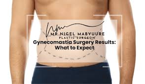 Image result for Gynecomastia