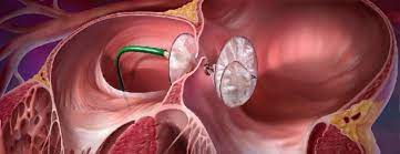 Born With Heart Defect But Living Longer Healthcare In Europe Com