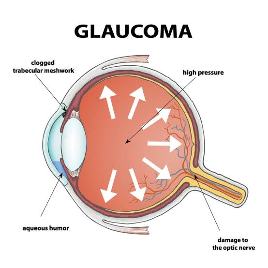 What Is Glaucoma? - Ventura County Lasik
