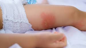The cause of milk allergy remains unknown as do prevention strategies, but your healthcare provider may be able to provide guidance for parents of new babies if someone in the family has been found to have a certain type of allergy. Expert Advice Why Did My Breastfeeding Baby Have An Allergic Reaction After I Drank Milk