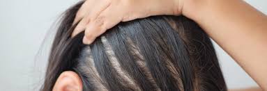 Women with health conditions that cause hormone imbalances also have a higher risk of hair loss. How To Handle Treat Female Hair Loss Dermatology Mohs