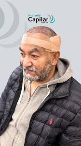 Nuestro paciente vino desde Santiago de Chile a atenderse con nosotros y  nos cuenta su experiencia saliendo de su procedimiento de Implante  Capilar!, No esperés más para recuperar tu cabello!, ...