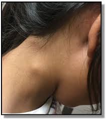 We did not find results for: Neck Mass In A Young Girl