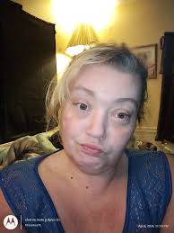 Hospitalization and Rehabilitation Setback Due to Wound Complications