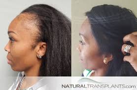 Body-Hair-Transplant