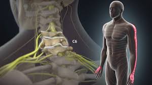 Radiculopathy Arm Pain Usc Spine Center Los Angeles