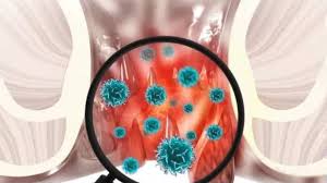 Image result for Blood in stool