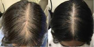 Usually this state of hairloss is temporary and the hair will grow back over time. Aldactone For Female Pattern Hair Loss