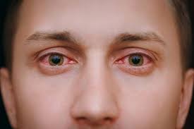 Why You Shouldn T Rub Your Eyes What Causes Red Eyes Red Eye Infection Red Eye Causes