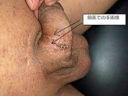 症例31 20代男性 修正手術（症例写真有り） | 山本クリニック｜鳥取県米子市