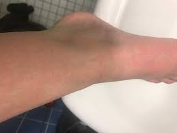 Blaue Beine Mit Roten Flecken Gesundheit Und Medizin Blaue Flecken