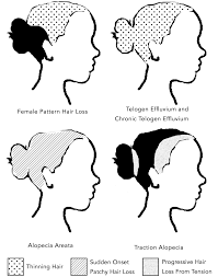The reasons for female pattern hair loss are not totally understood, although it is thought to be related to a family history of male or female baldness thyroid disease, diabetes, lupus or anemia are among the 30 or so diseases that can cause sudden hair loss, according to the american academy of. Treating More Than One Hair Loss Condition Simultaneously