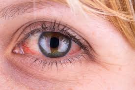 Rote Augen: Ursachen und Behandlung | BRIGITTE.de