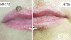 It will not cause further damage your skin. Before After 1 Magnetic Pmu Tattoo Removal By Linda Paradis Youtube
