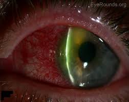 Epithelial disease, usually caused by. Corneal Marginal Ulcer