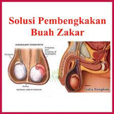 Dok saya mau tanya buah zakar sblh kanan terasa ngilu bila di pegang m ukuran lebih besar dr pada yg kiri. Jual Obat Hidrokel Pembengkakan Buah Zakar Pembengkakan Testis Buah Zakar Bengkak Sebelah Aman Untuk Bayi Balita Dan Anak Anak Di Lapak Dedita Herbal Store Bukalapak