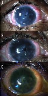 Millennialeye Buccal Mucous Membrane Transplantation In Stevens Johnson Syndrome