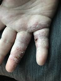 Image result for dermatitis contacta children
