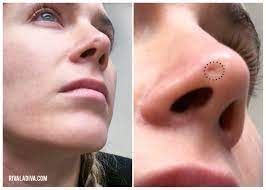 In some people, bccs can resemble noncancerous skin conditions such as psoriasis or eczema. Let S Talk Skin Cancer Riva La Diva