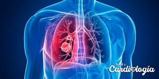 La trombosis venosa profunda es una afección médica grave pero prevenible en la que se forman coágulos de sangre, generalmente en las venas de la parte inferior de la pierna, el muslo, la pelvis y, a veces, los la embolia pulmonar (ep) a menudo se asocia con trombosis venosa profunda (tvp). Que Es Un Tromboembolismo Pulmonar Salud Y Cardiologia
