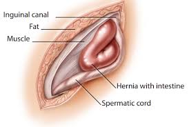 Image result for Inguinal hernia child