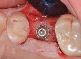 Simultaneous Crestal Sinus Elevation And Implant Placement Using A Ribose Cross Linked Collagen Bone Graft Material Case Series Of 28 Consecutive Patients