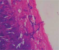 La mucormicosis (anteriormente conocida como cigomicosis) es una enfermedad rara, no se trata de una enfermedad contagiosa, los mucorales se encuentran en el ambiente y pueden entrar por vías. Mucormicosis Gastrointestinal En Paciente Diabetico Reporte De Un Caso Y Revision De La Literatura Sciencedirect