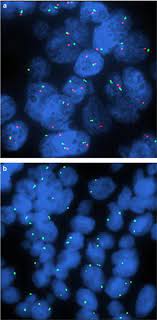 mesothelioma is a type of cancer that develops from the thin layer of tissue that covers many of the internal organs (known as the mesothelium). Bap1 Brca1 Associated Protein 1 Is A Highly Specific Marker For Differentiating Mesothelioma From Reactive Mesothelial Proliferations Modern Pathology