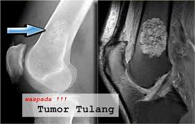 Tumor Tulang Adalah Terjadinya Jaringan Atau Sel Sel Yang Tumbuh Secara Abnormal Pada Tulang Dan Hingga Saat Ini Penyebab Utamanya Belum Tulang Genetik Kimia