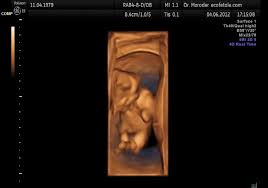We offer ultrasound packages that allow multiple visits because many families like to come more than once to see baby as he/she grows. File Fetal Movements 3d Ultrasound Dr Wolfgang Moroder Theora Ogv Wikimedia Commons