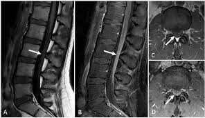 The study findings are published in the journal neurological research. Nerve Root Enhancement In Guillain Barre Syndrome Practical Neurology